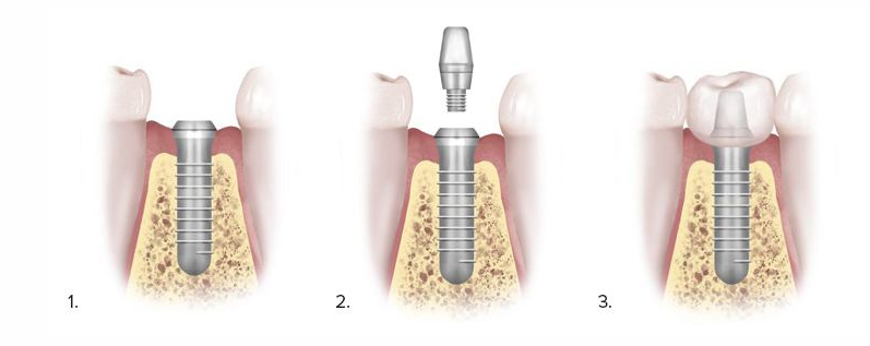 Dental Implant Illustration