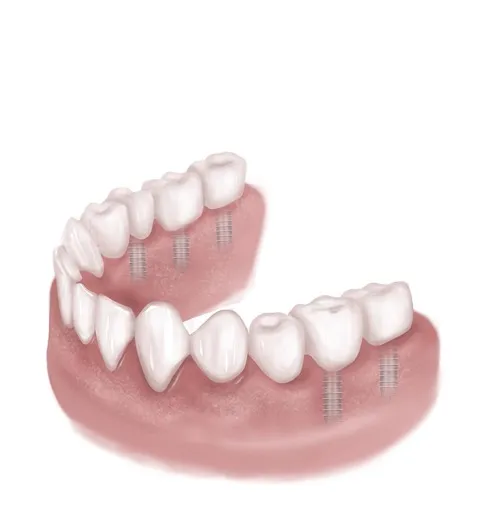 Alternative Dental Treatment Options